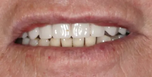 before and after smile comparison
