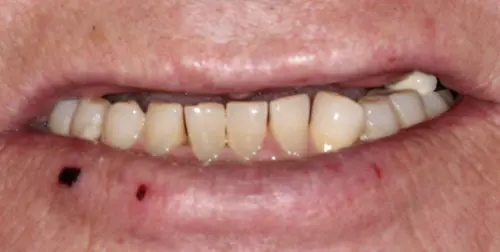 before and after smile comparison