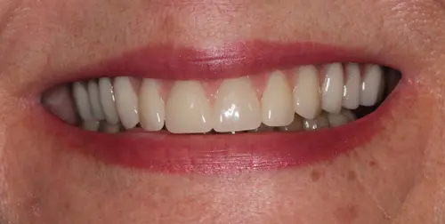 before and after smile comparison