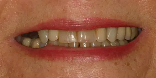 before and after smile comparison