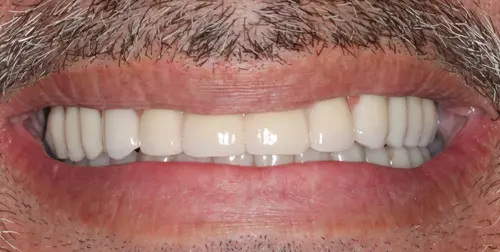 before and after smile comparison