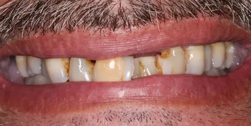 before and after smile comparison