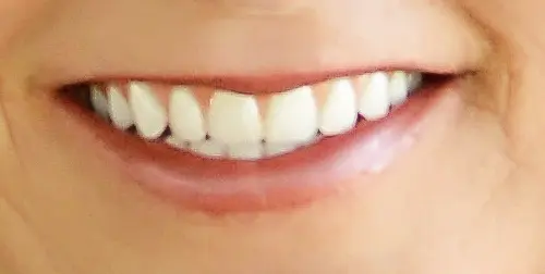 before and after smile comparison