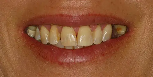 before and after smile comparison