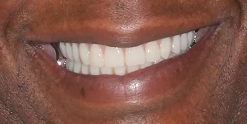 before and after smile comparison