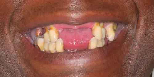 before and after smile comparison