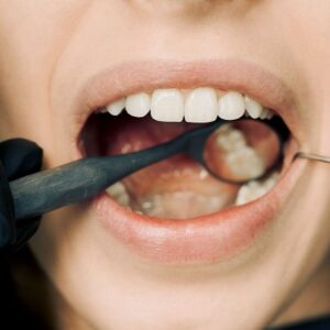 A close-up view of an open mouth during a dental examination with a dental mirror.