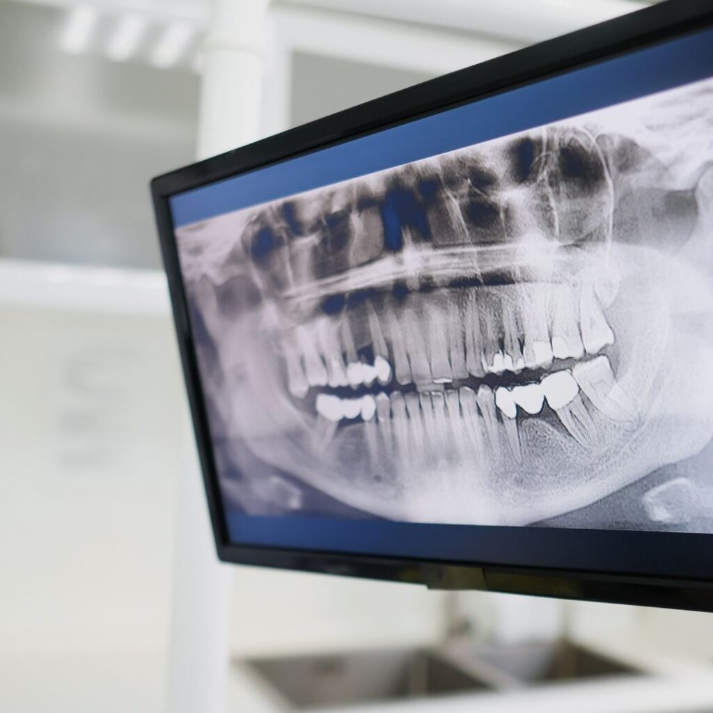 teeth x-ray scan