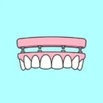 implants-all-on-4 icon graphic