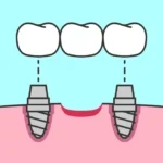 implants-multiple-tooth icon graphic